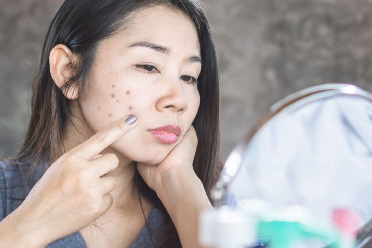 傷跡のにきびからのダークスポットで彼女の顔の皮膚の問題をチェックする不幸なアジアの女性